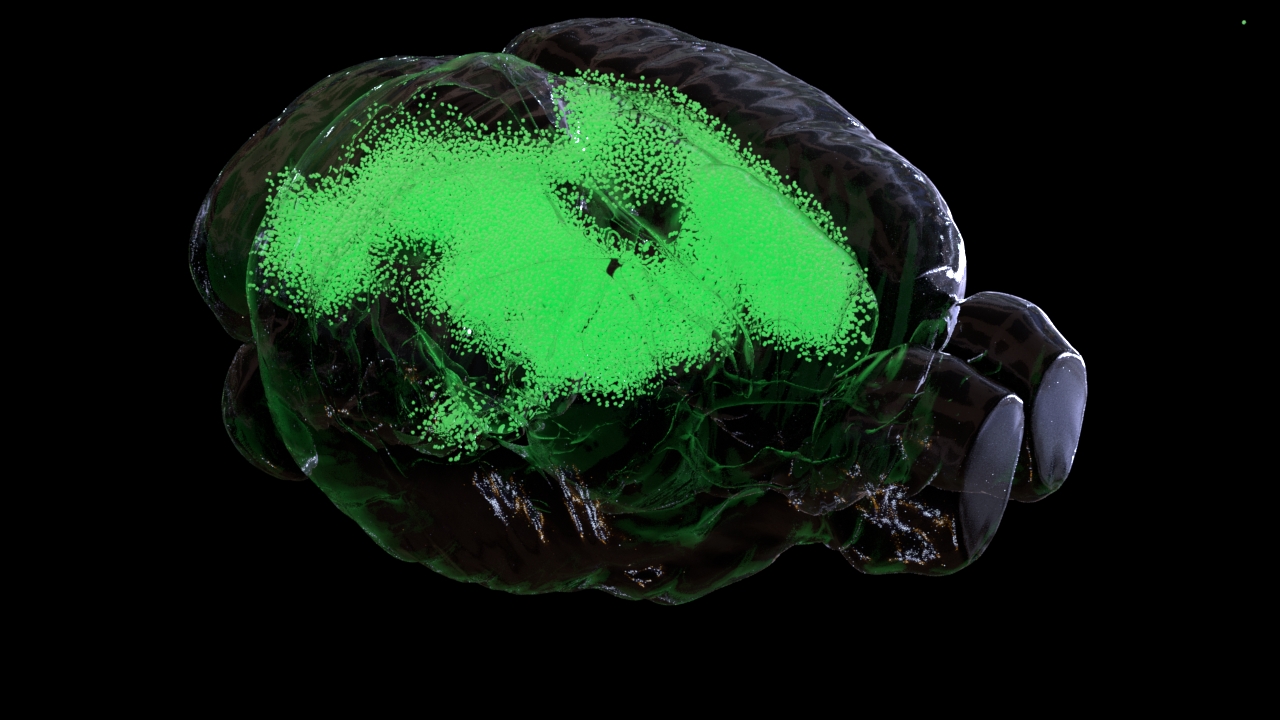Three-dimensional brain tumor reconstruction